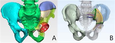 Clinical exploration of the international society of limb salvage classification of endoprosthetic failure using Henderson in the application of 3D-printed pelvic tumor prostheses